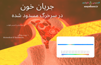 جریان خون در سرخرگ مسدود شده، شبیه سازی با انسیس فلوئنت